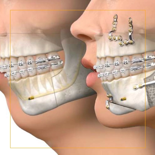 Jaw Prosthesis
