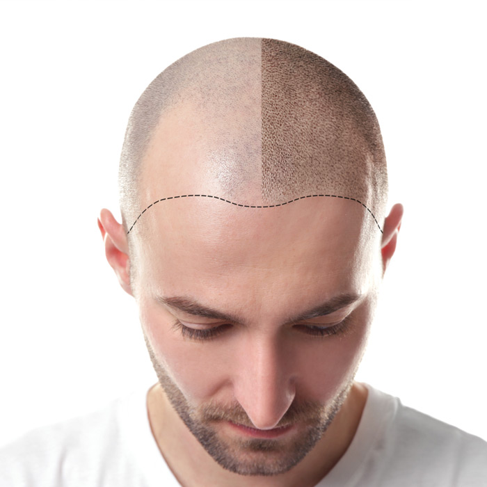 Hair Transplant